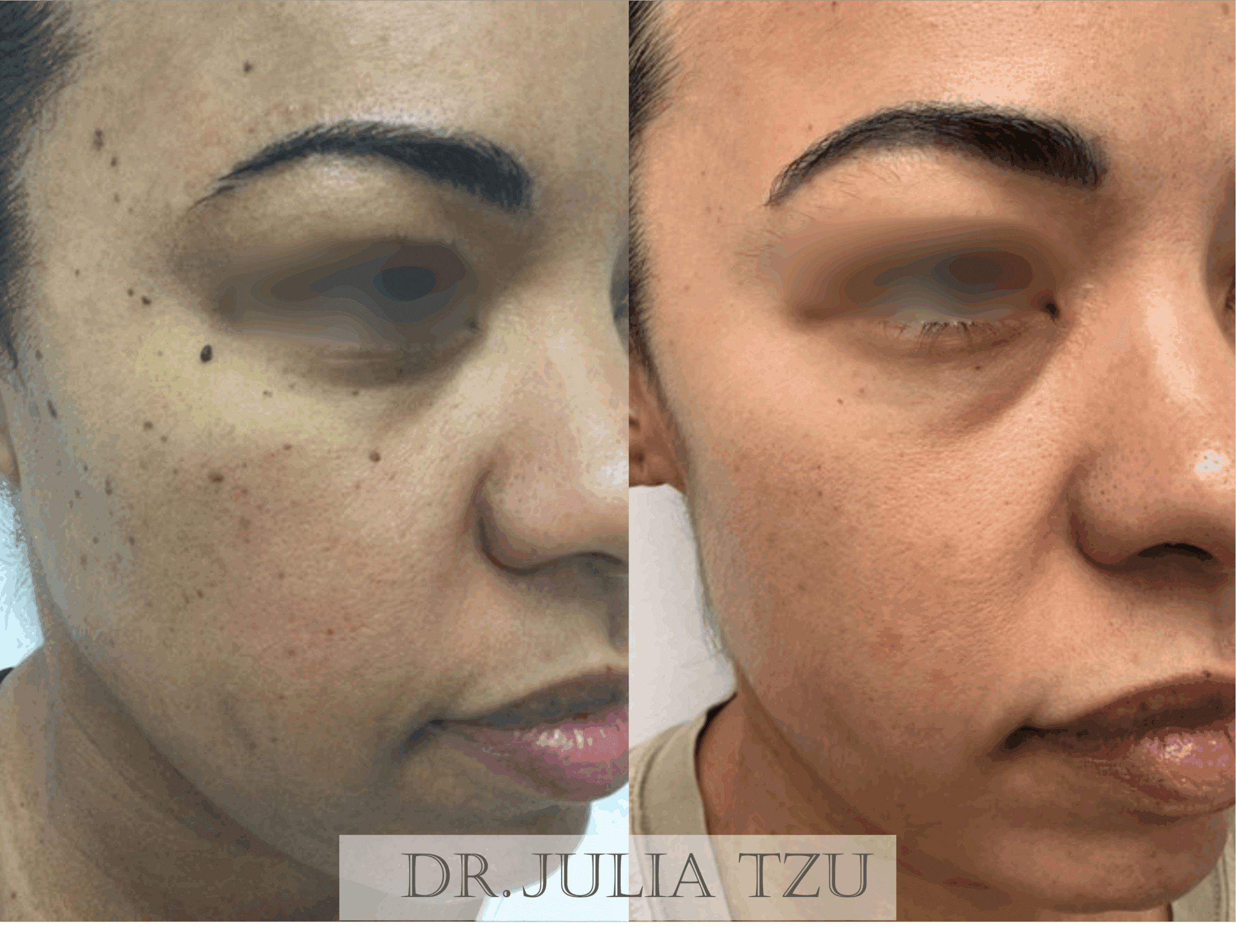 Before and after mole removal procedure by Dr. Julia Tzu in New York