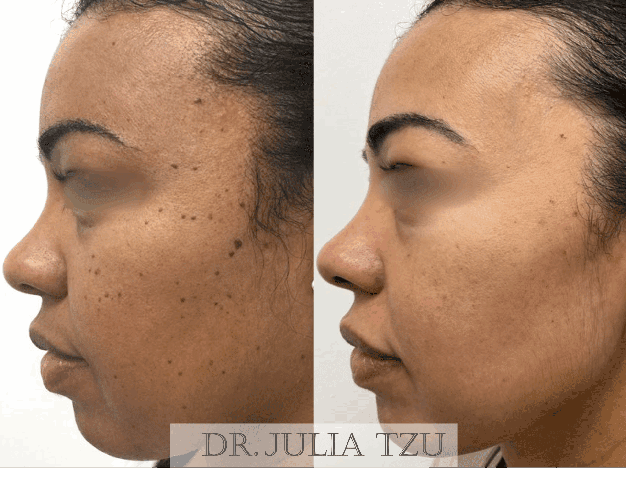 Before and after mole removal on face by Dr. Julia Tzu in Manhattan