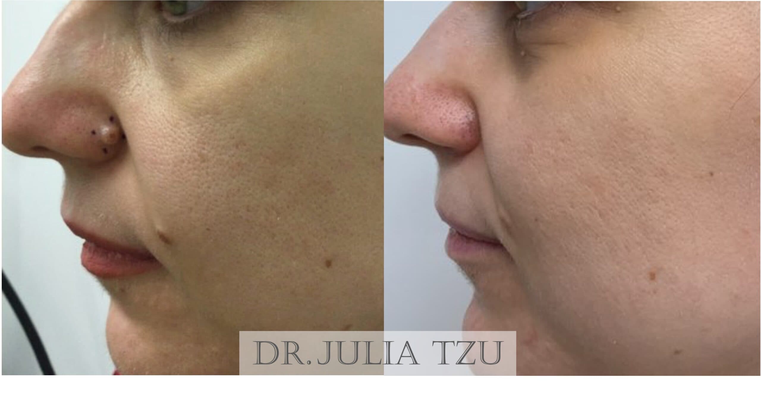 Before and after surgical mole removal result by Dr. Julia Tzu