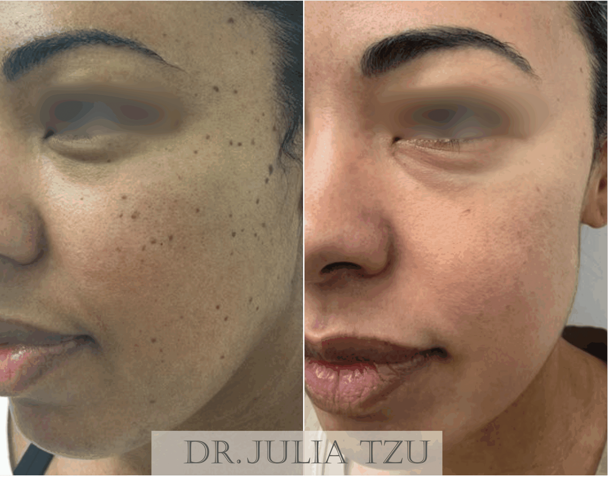 Before and after cosmetic mole removal result by Dr. Julia Tzu
