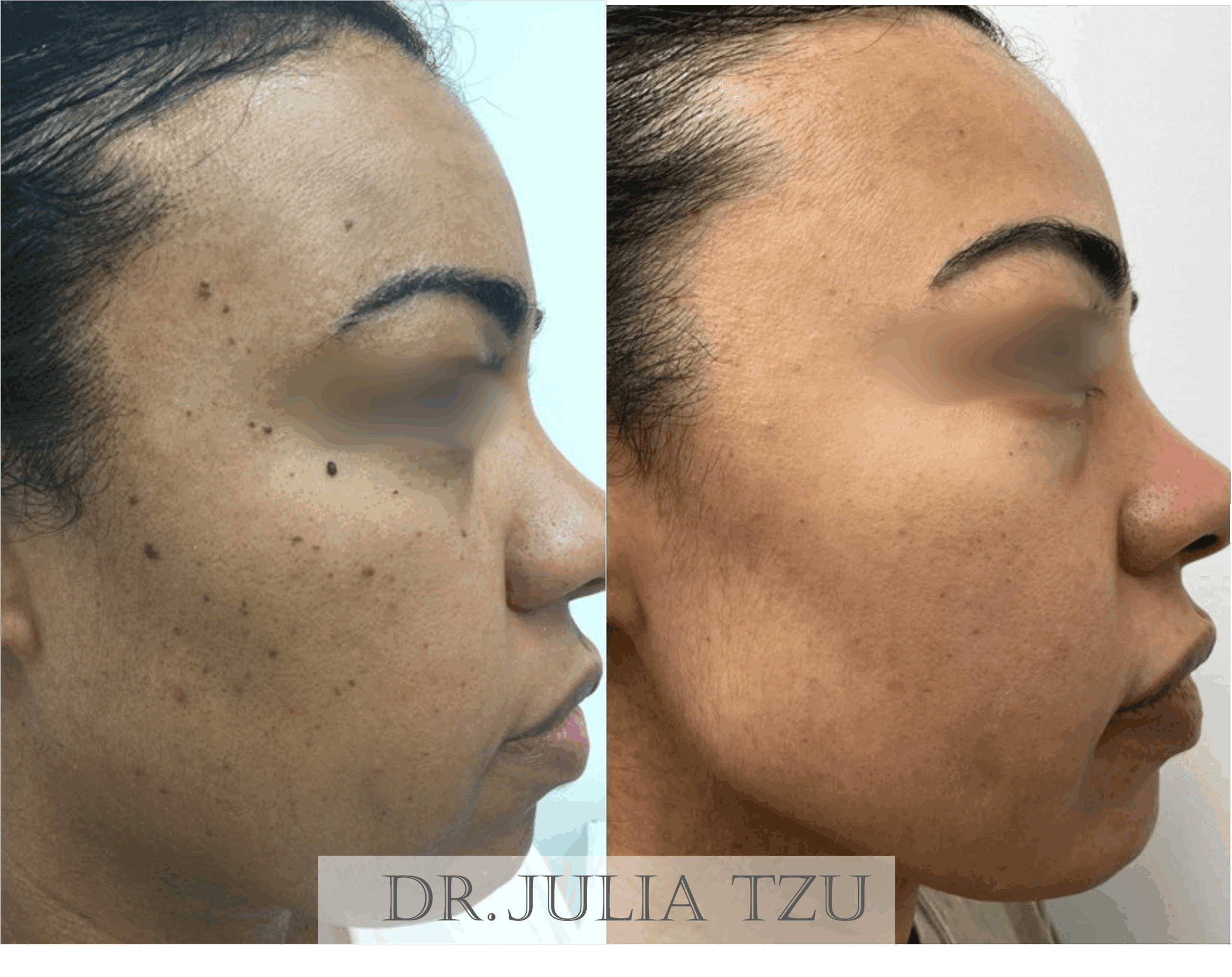 Before and after facial mole removal result by Dr. Julia Tzu at Wall Street Dermatology