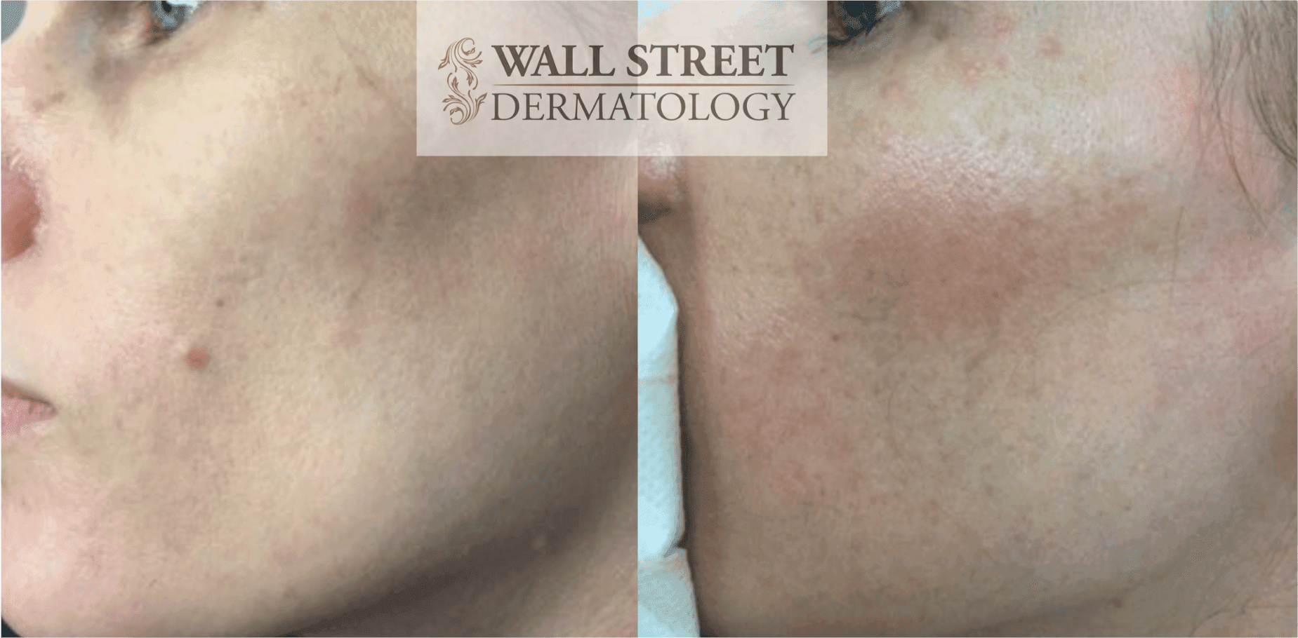Before and after cheek mole removal by Dr. Julia Tzu at Wall Street Dermatology