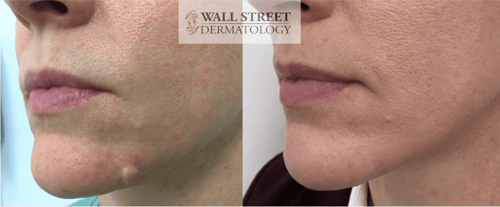 Before and after chin mole removal by Dr. Julia Tzu at Wall Street Dermatology