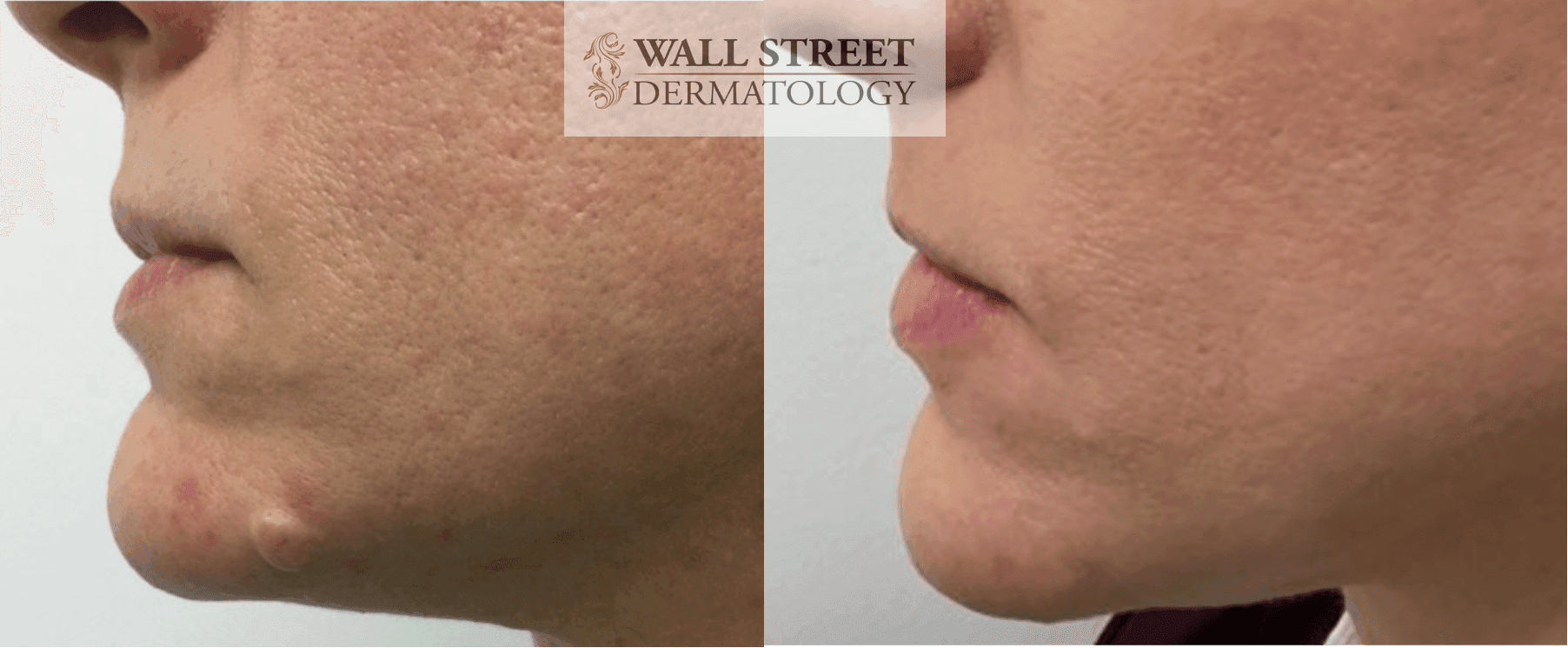 Before and after chin mole removal with healing result by Dr. Julia Tzu