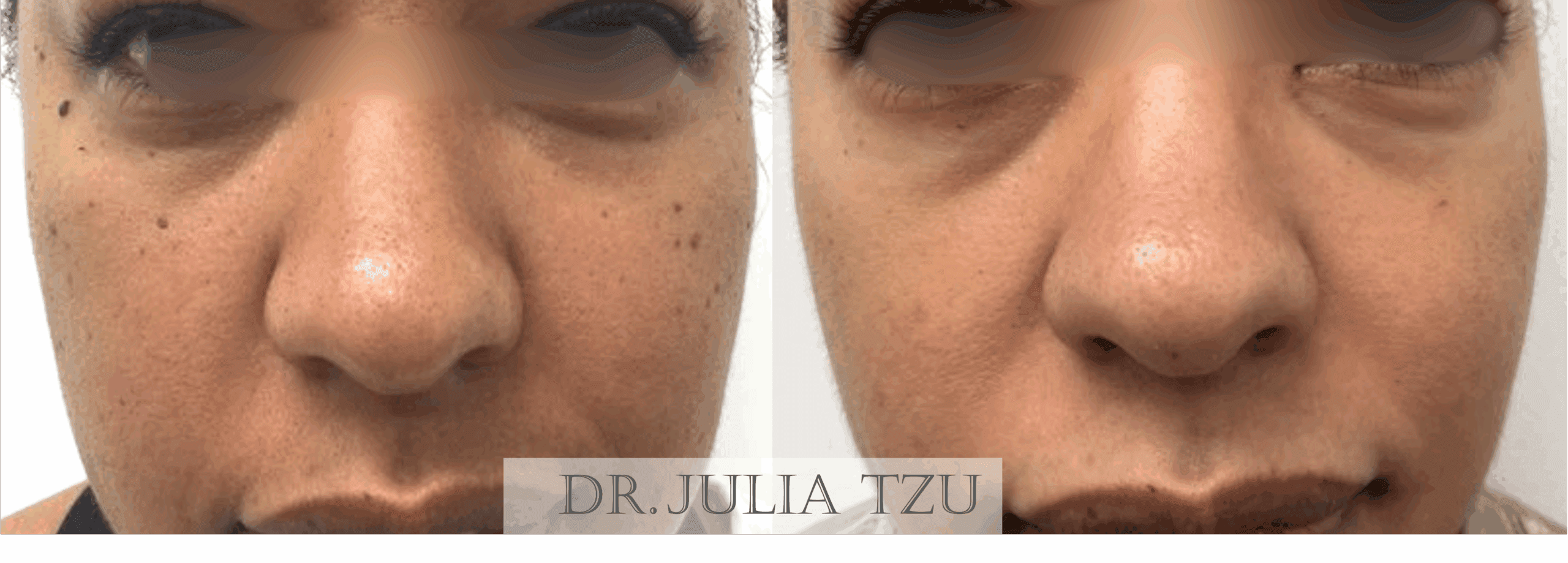 Before and after mole removal by Dr. Julia Tzu at Wall Street Dermatology NYC