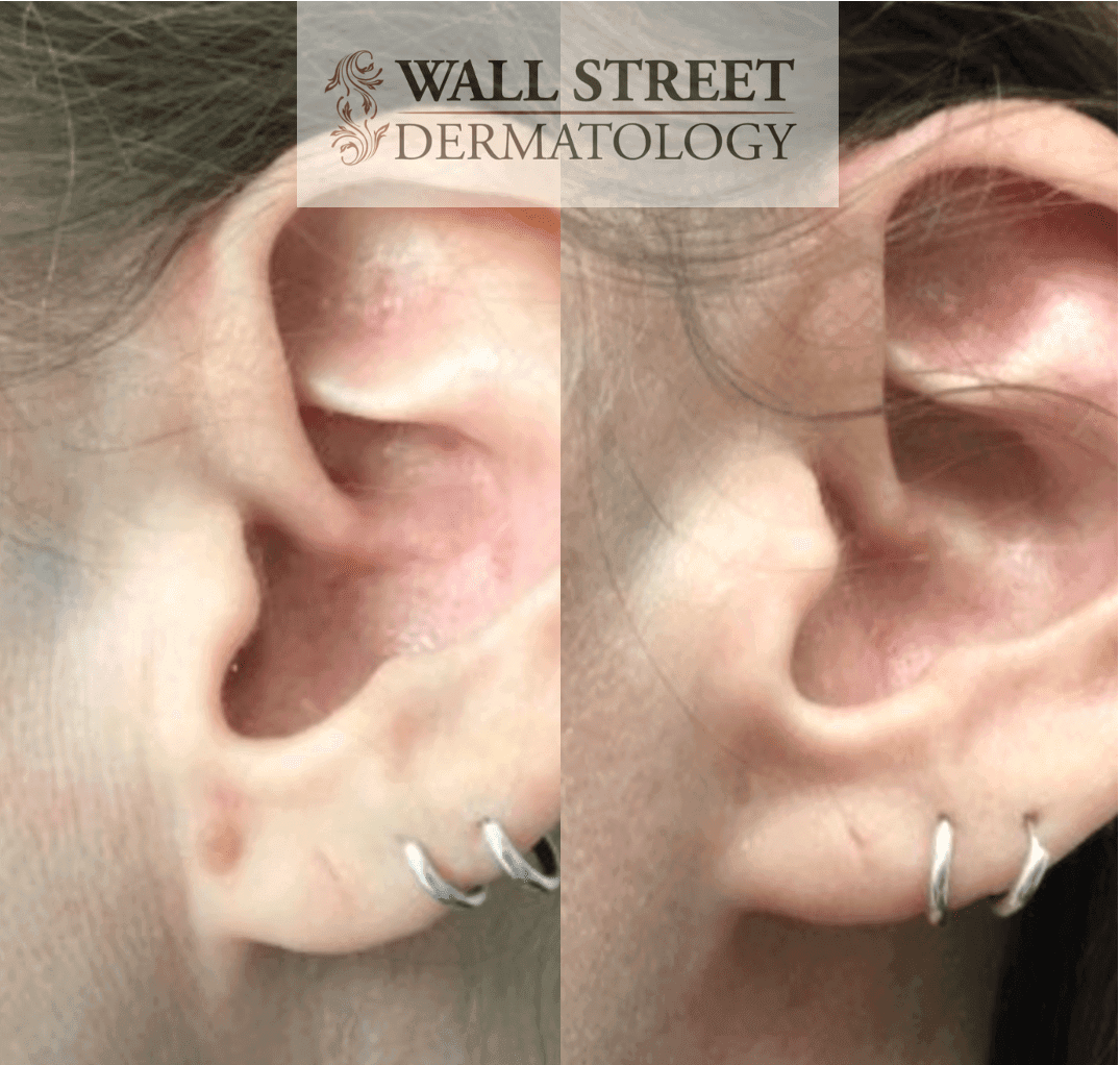 Before and after ear mole removal by Dr. Julia Tzu at Wall Street Dermatology