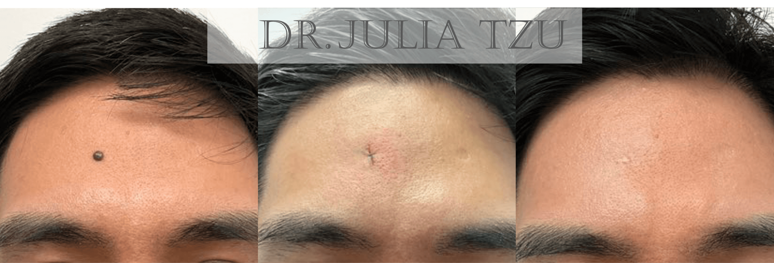 Before, during, and after forehead mole removal showing healing progression by Dr. Julia Tzu