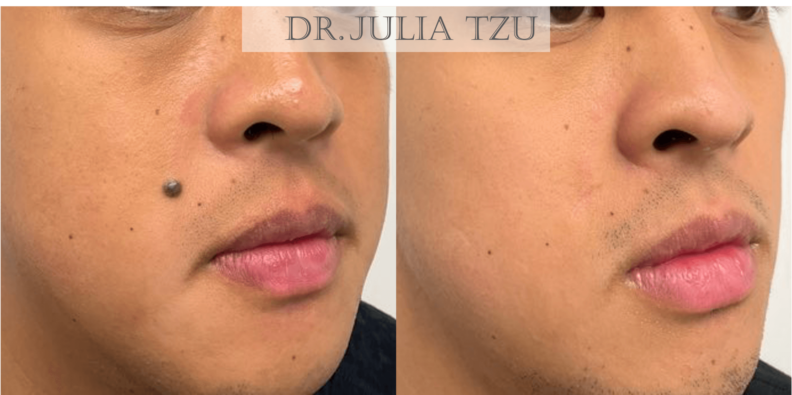 Before and after surgical mole removal on the cheek by Dr. Julia Tzu at Wall Street Dermatology