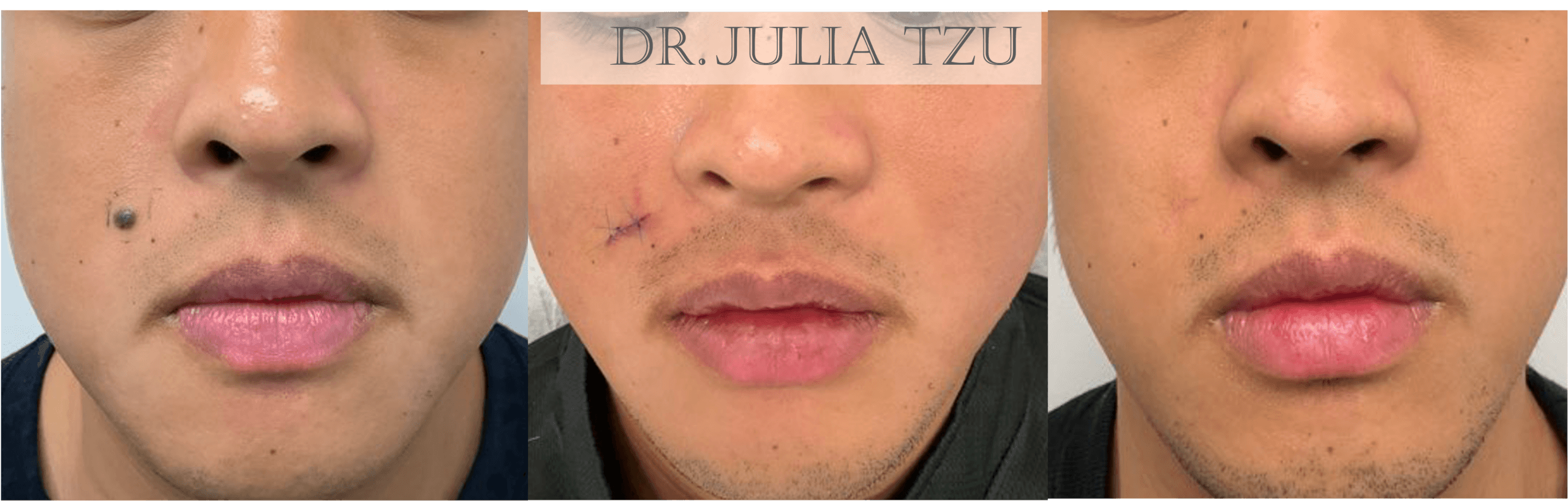 Before, during, and after surgical mole removal on the cheek showing healing progression by Dr. Julia Tzu