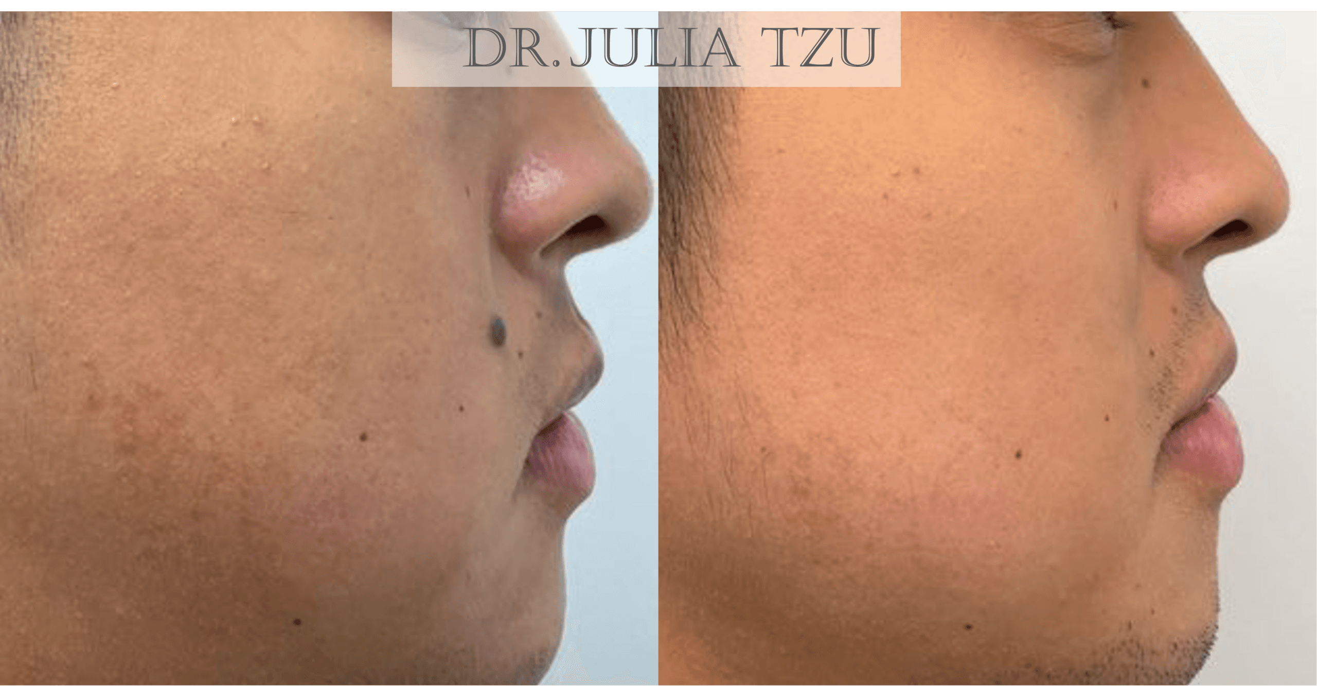 Before and after surgical mole removal on the cheek, profile view, by Dr. Julia Tzu in Manhattan
