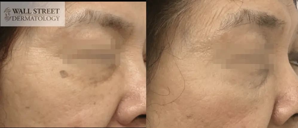 Brown spot removal via hyfrecation