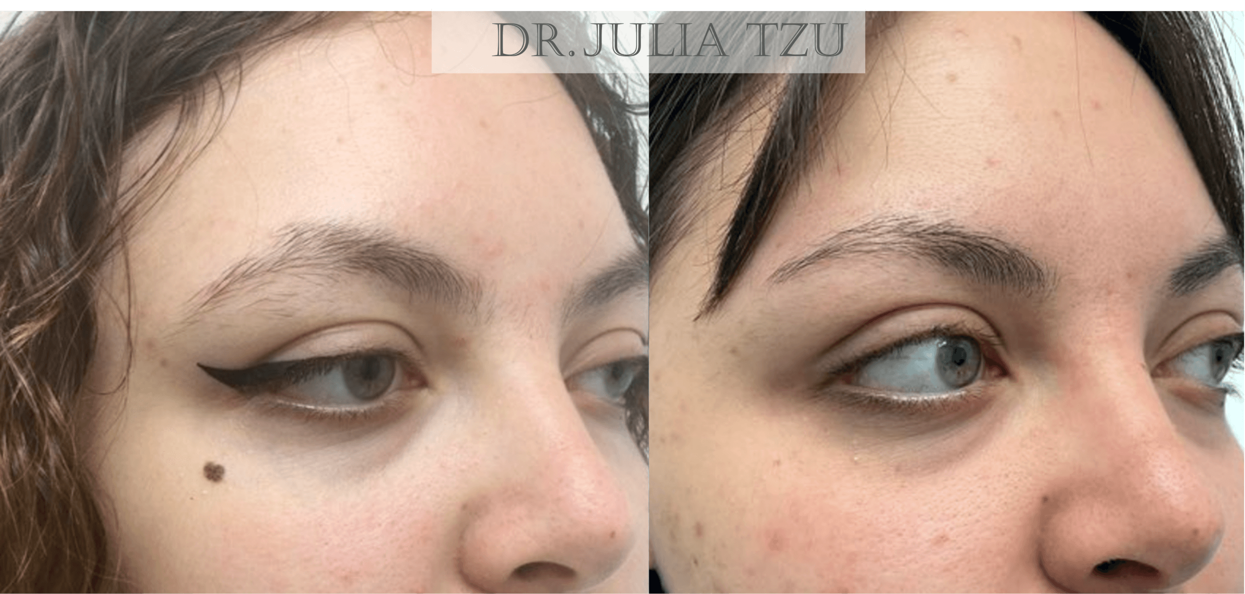 Before and after facial mole removal result by Dr. Julia Tzu in NYC