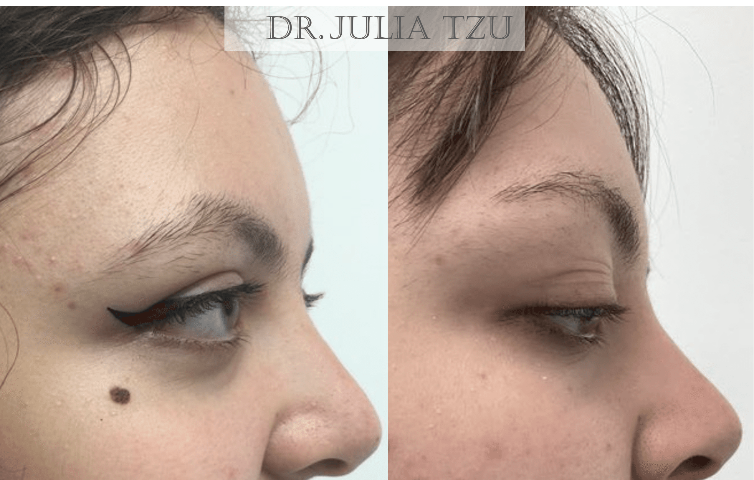 Before and after cheek mole removal by Dr. Julia Tzu at Wall Street Dermatology