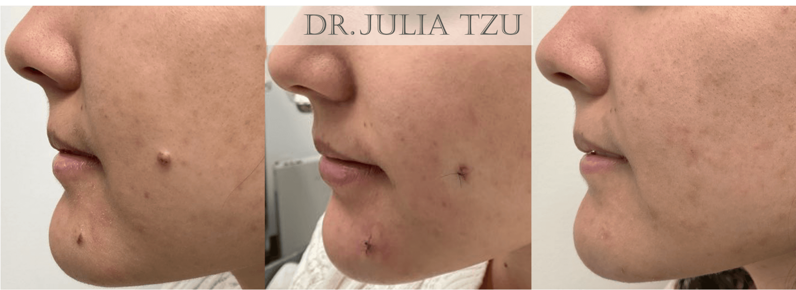 Before, after surgery, and six months after cosmetic mole removal on the cheek and chin, profile view, by Dr. Julia Tzu