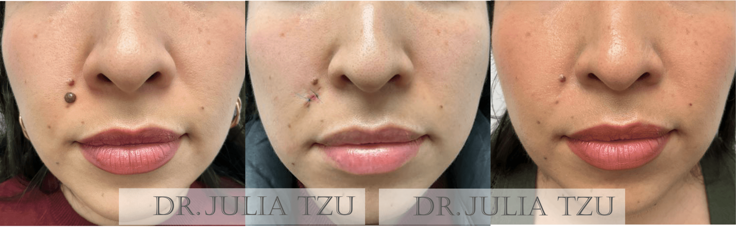 Before, during, and after cosmetic mole removal on the cheek showing healing progression by Dr. Julia Tzu