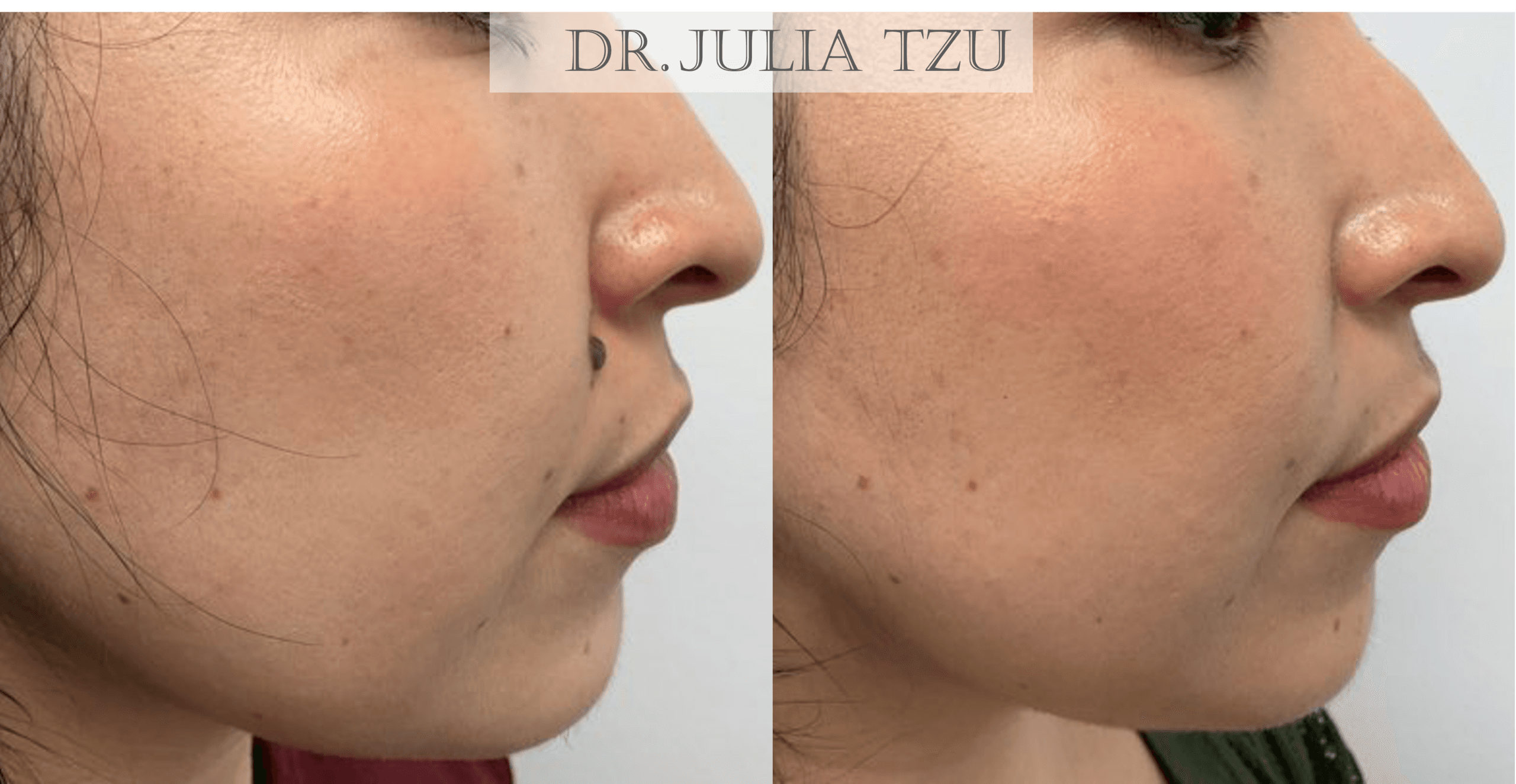 Before and after surgical cosmetic mole removal on the cheek, profile view, by Dr. Julia Tzu