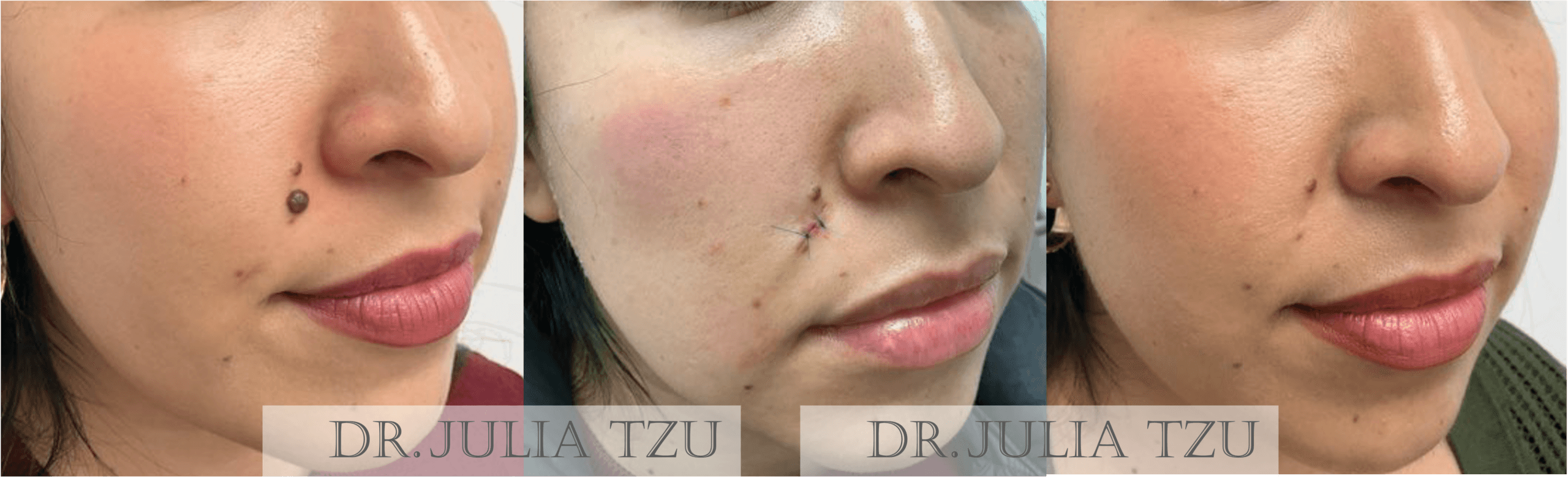 Before, during, and after surgical cosmetic mole removal on the cheek, oblique view, showing healing by Dr. Julia Tzu
