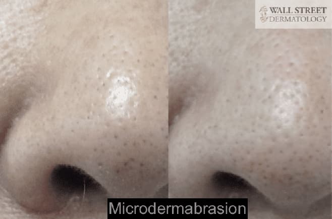 Microdermabrasion Before and After