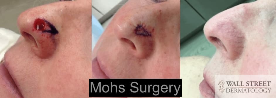 Mohs Surgery Before and After