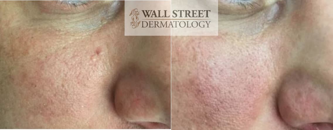 Before and after shave mole removal by Dr. Julia Tzu at Wall Street Dermatology