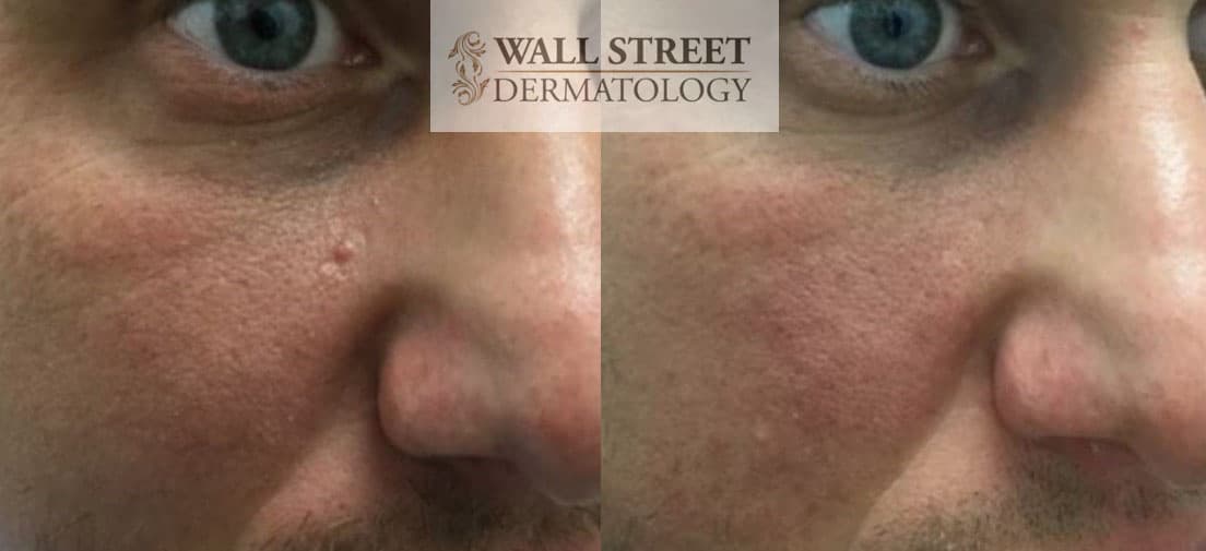 Before and after mole removal result by Dr. Julia Tzu in Manhattan