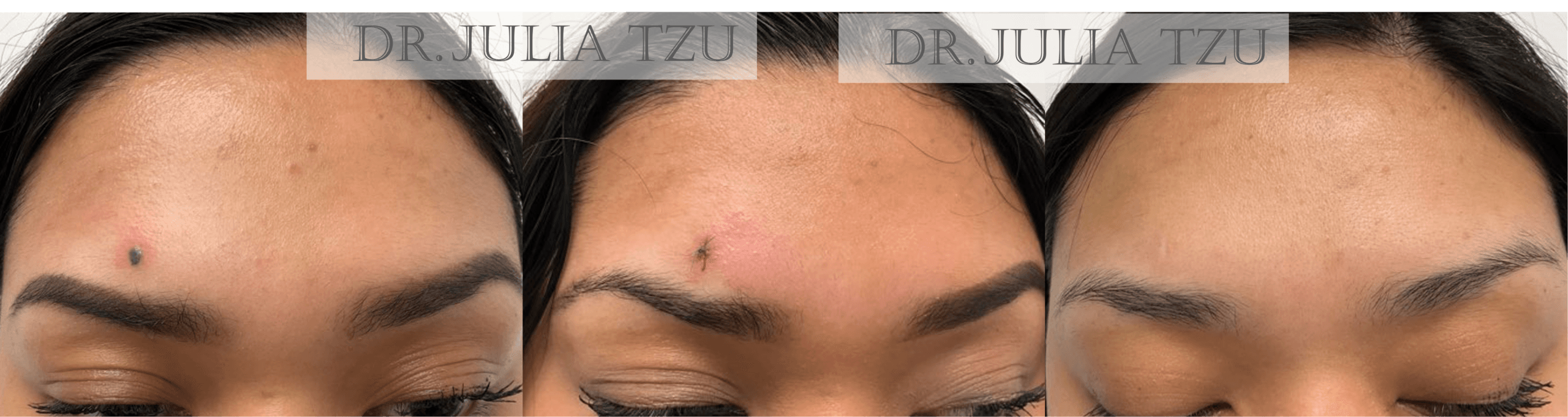 Before and after cosmetic mole removal showing healing by Dr. Julia Tzu