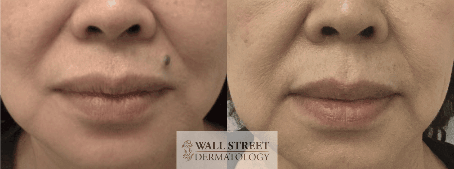 Before and after mole removal near upper lip, facial mole shave removal by Dr. Julia Tzu