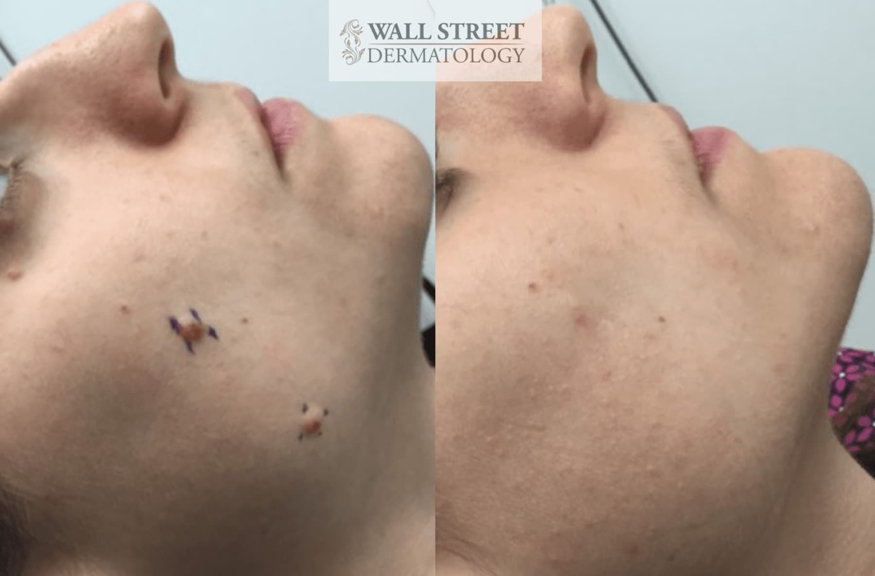 Before and after surgical mole removal by Dr. Julia Tzu in NYC