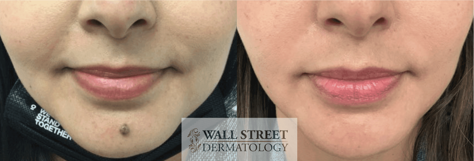 Before and after cosmetic mole removal by Dr. Julia Tzu in NYC