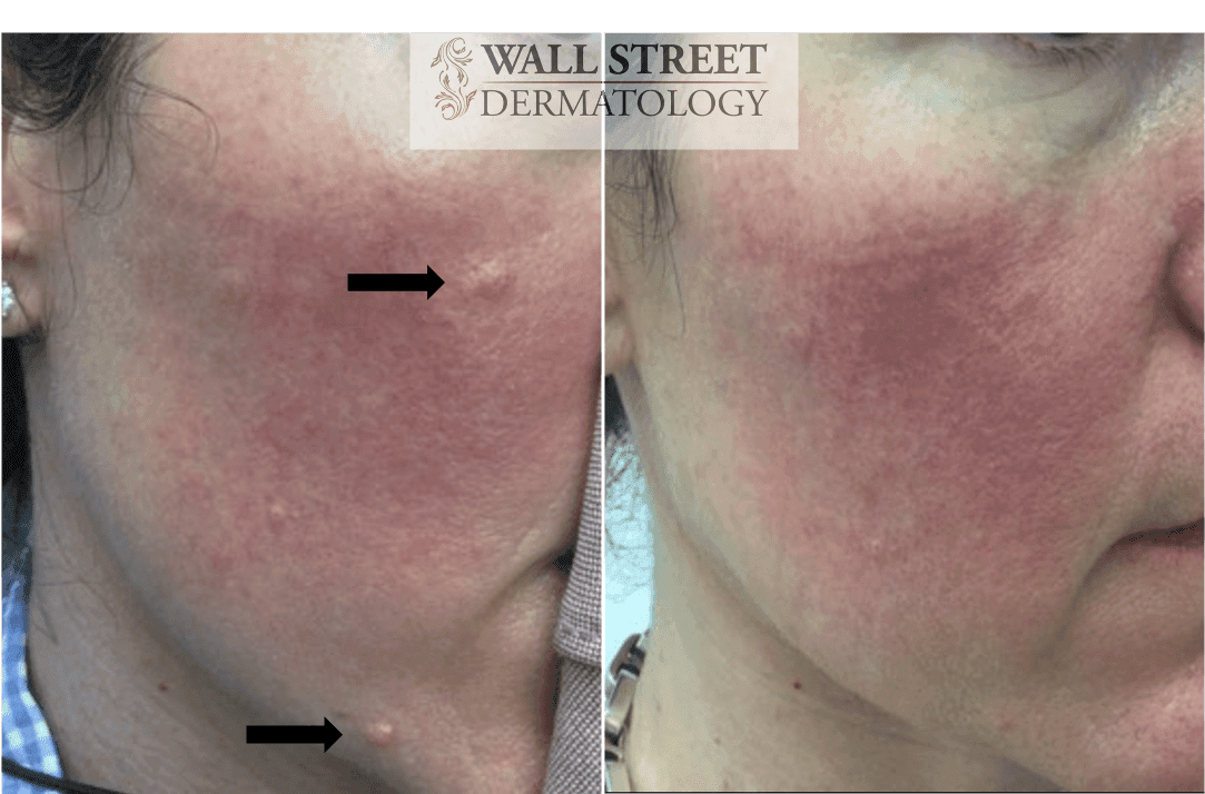 Before and after mole removal on face by Dr. Julia Tzu at Wall Street Dermatology