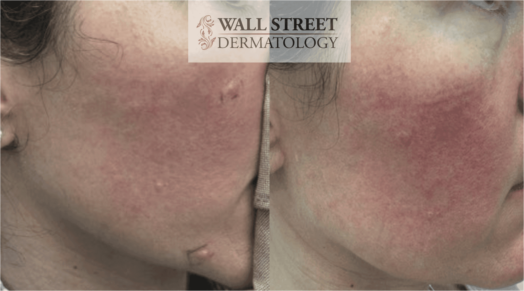 Before and after cosmetic mole removal showing healing progression by Dr. Julia Tzu