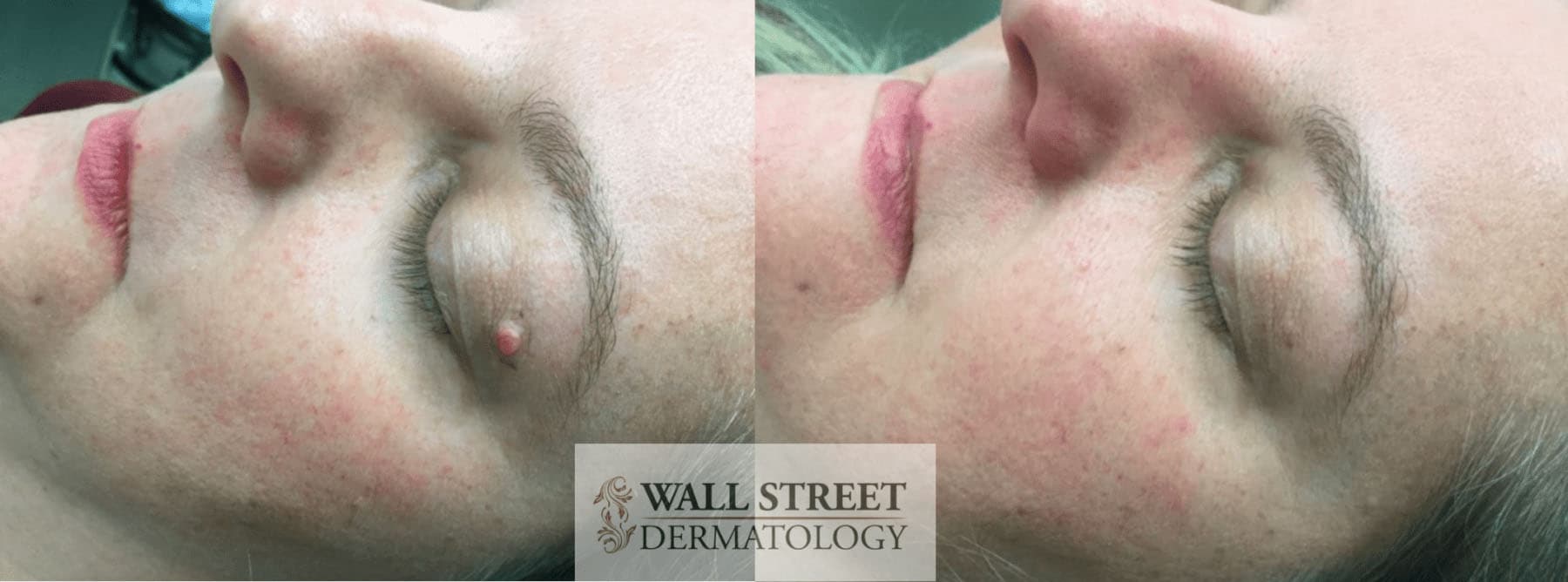 Before and after facial mole removal by Dr. Julia Tzu at Wall Street Dermatology