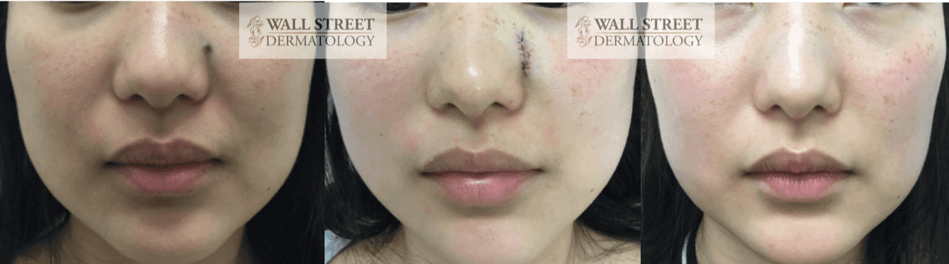 Before, during, and after facial mole removal showing healing progression by Dr. Julia Tzu