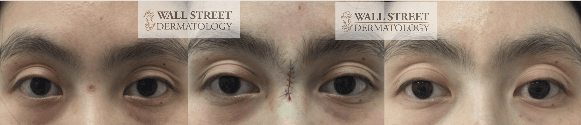 Before and after nasal mole removal by Dr. Julia Tzu in Manhattan