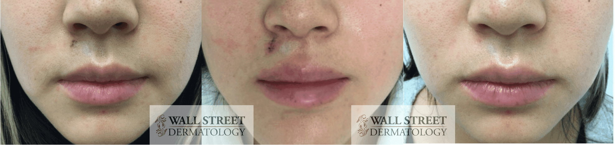 Before and after mole removal by Dr. Julia Tzu at Wall Street Dermatology