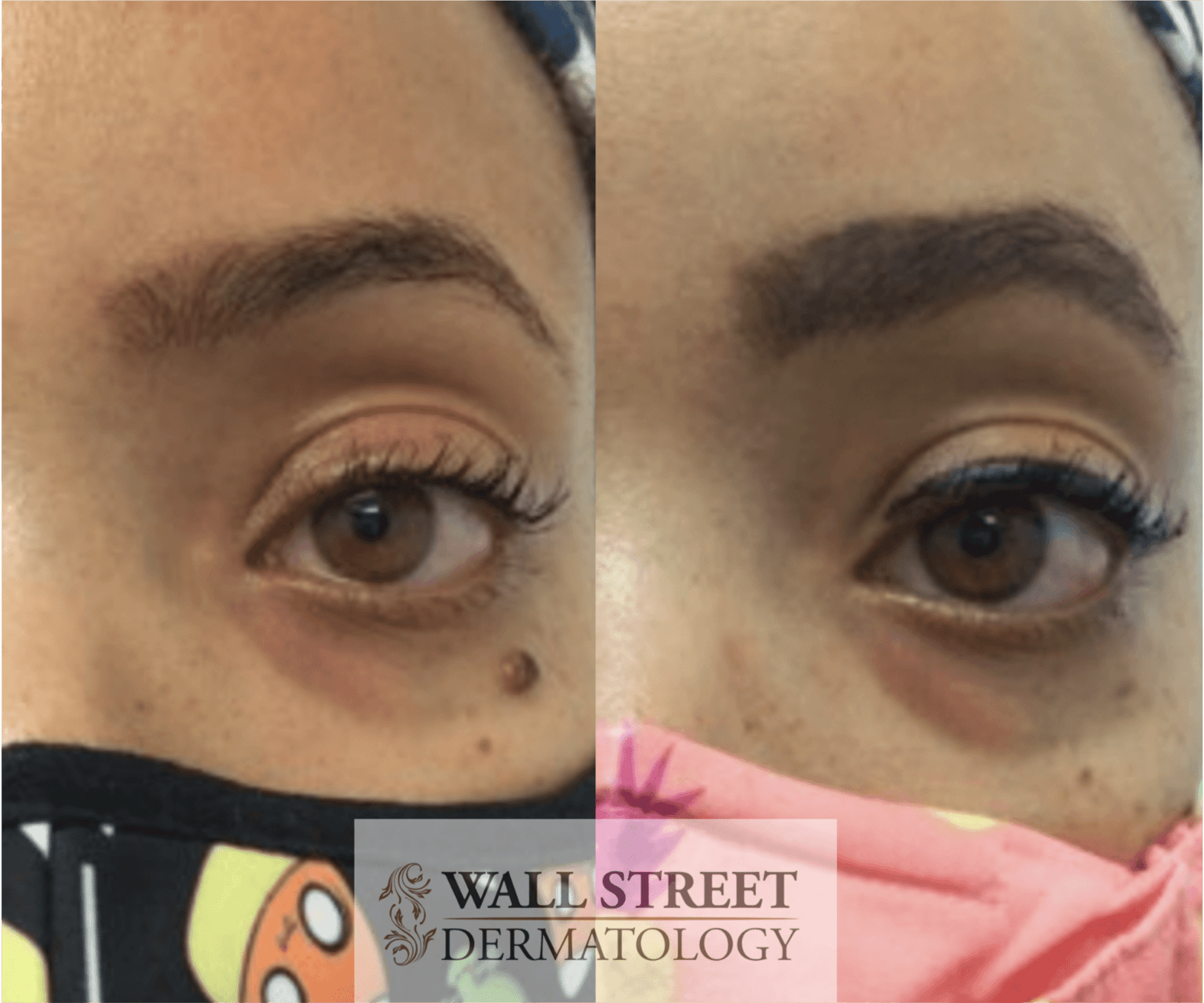 Before and after mole removal on face by Dr. Julia Tzu in New York