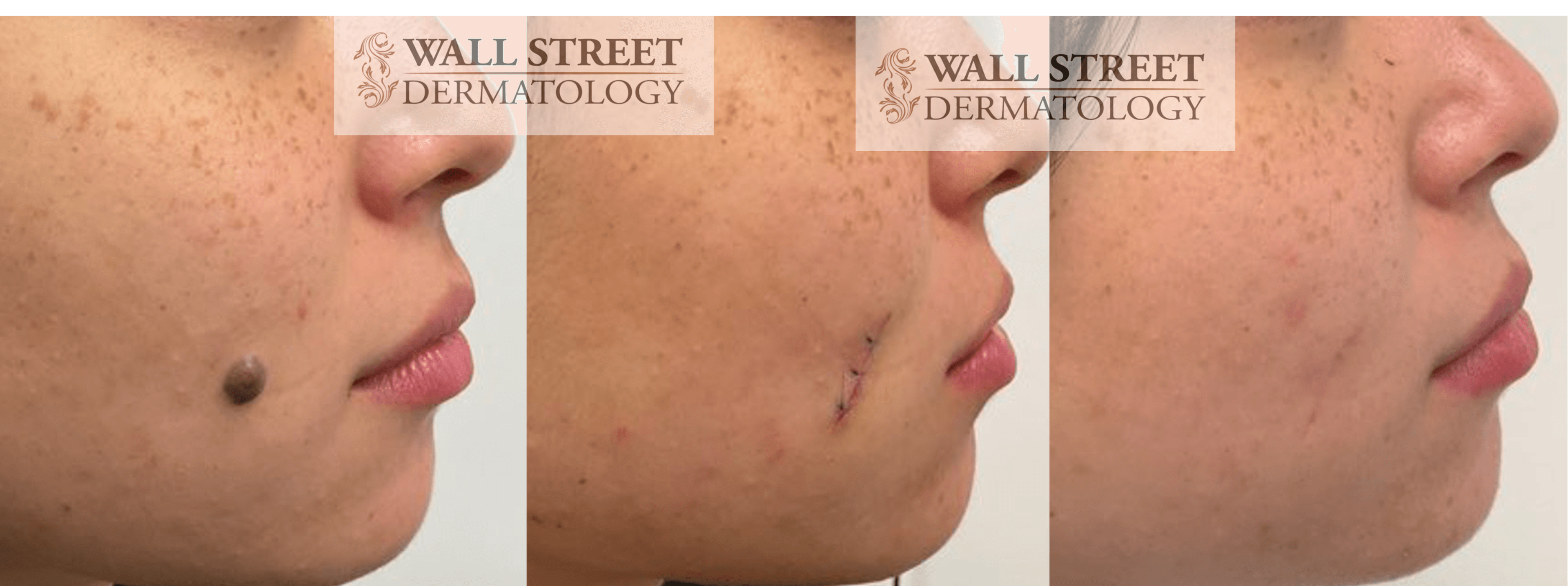 Before and after cosmetic mole removal result by Dr. Julia Tzu