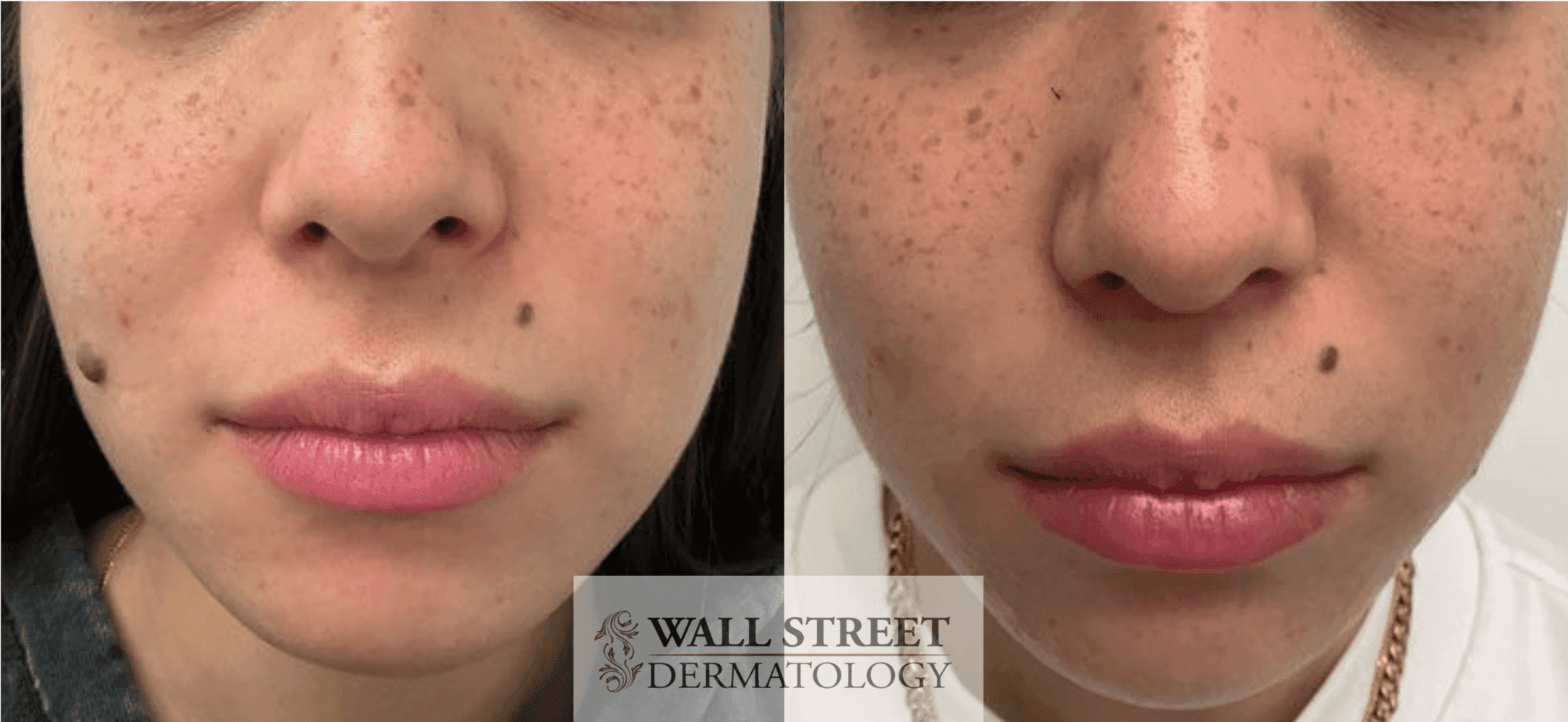Before and after mole removal procedure by Dr. Julia Tzu in Manhattan