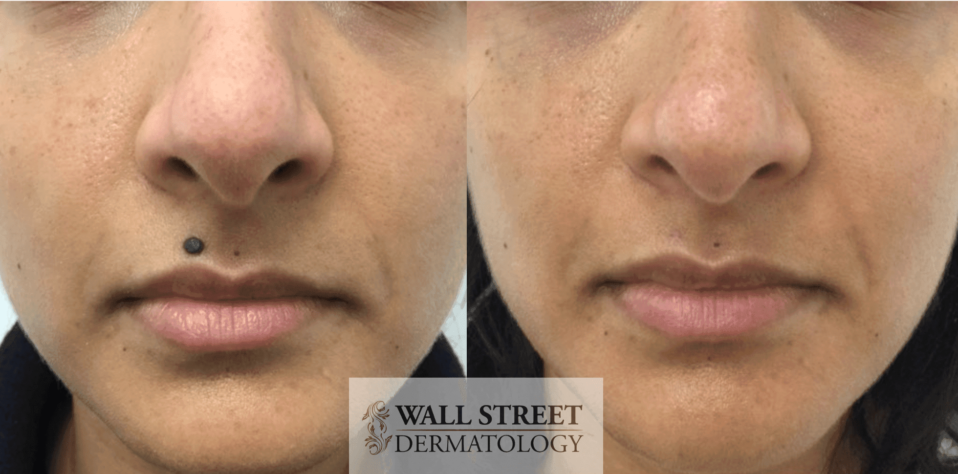 Before and after surgical mole excision by Dr. Julia Tzu at Wall Street Dermatology