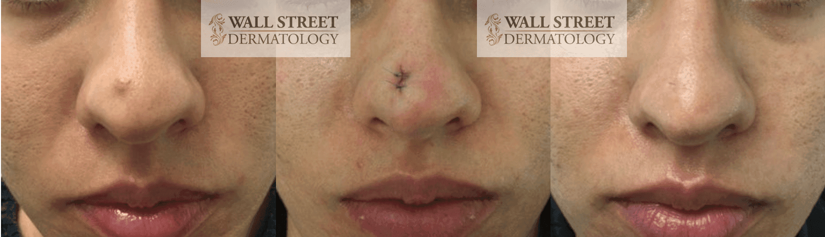 Before and after nose mole removal by Dr. Julia Tzu at Wall Street Dermatology