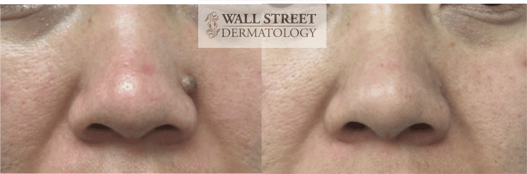 Before and after nose mole removal with healing progression by Dr. Julia Tzu