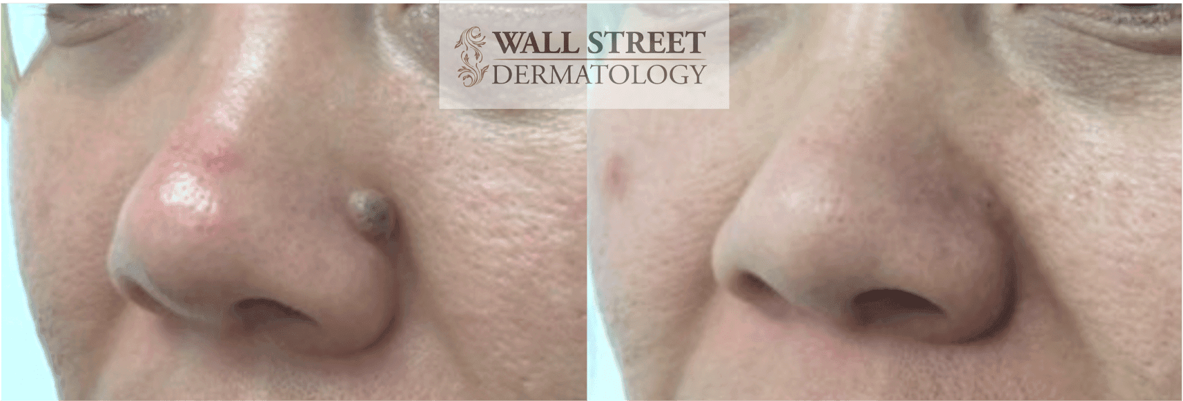 Before and after nose mole removal showing minimal scarring by Dr. Julia Tzu