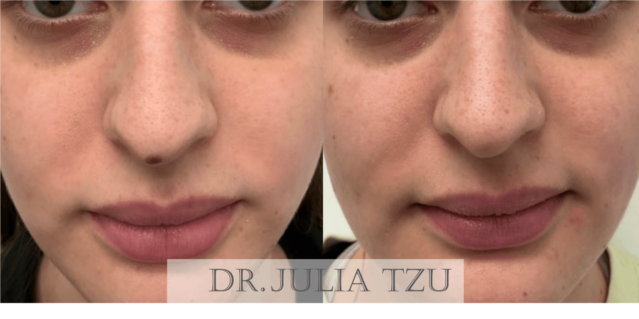 Before and after facial mole removal by Dr. Julia Tzu in NYC