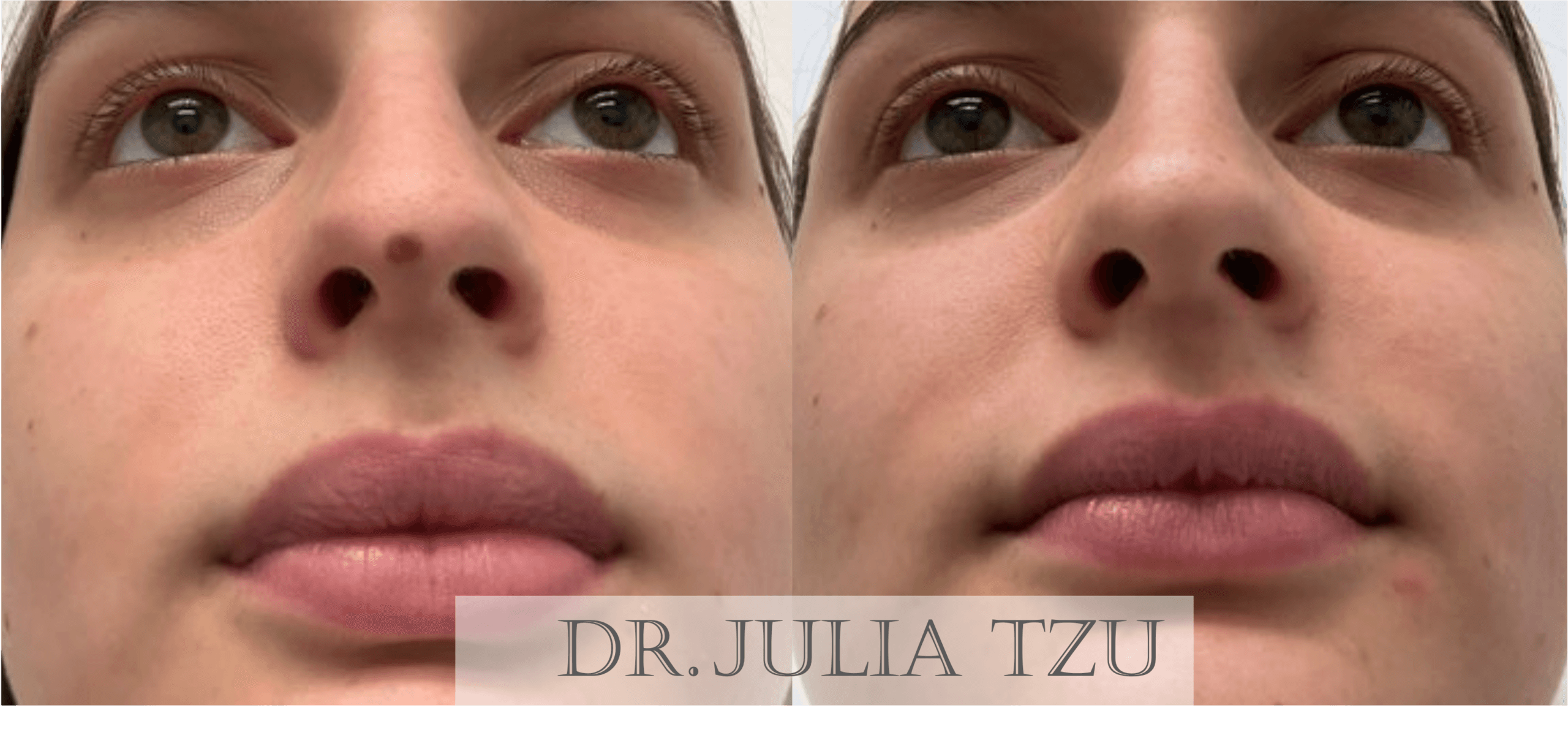Before and after mole removal on face by Dr. Julia Tzu at Wall Street Dermatology