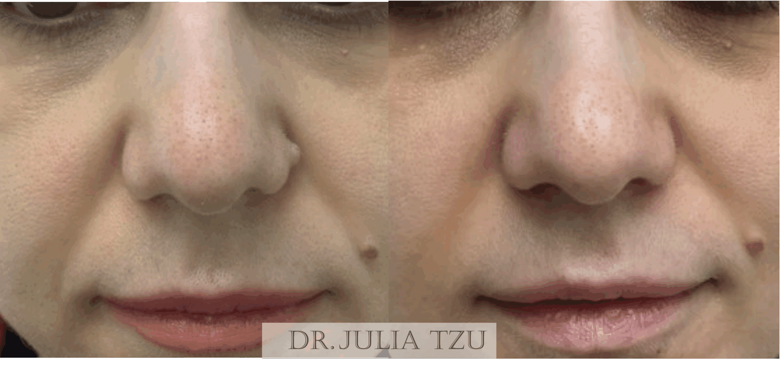 Before and after mole removal showing excellent cosmetic outcome by Dr. Julia Tzu