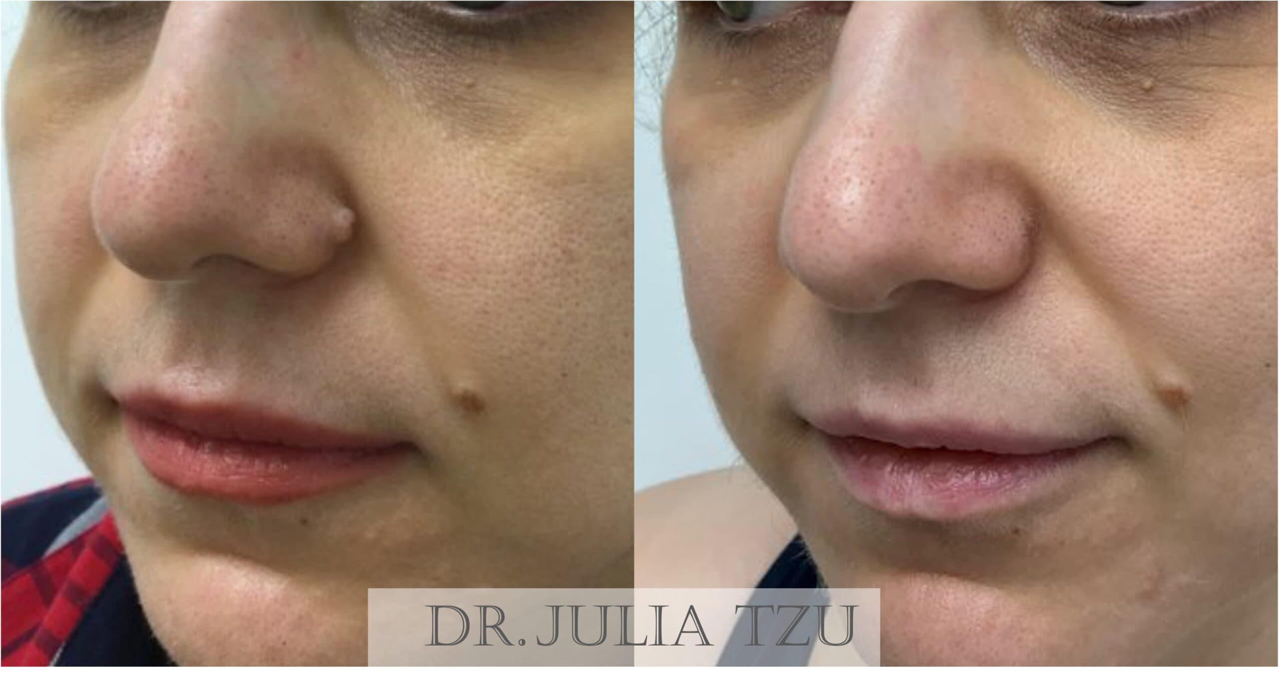 Before and after mole removal with minimal scarring by Dr. Julia Tzu in Manhattan