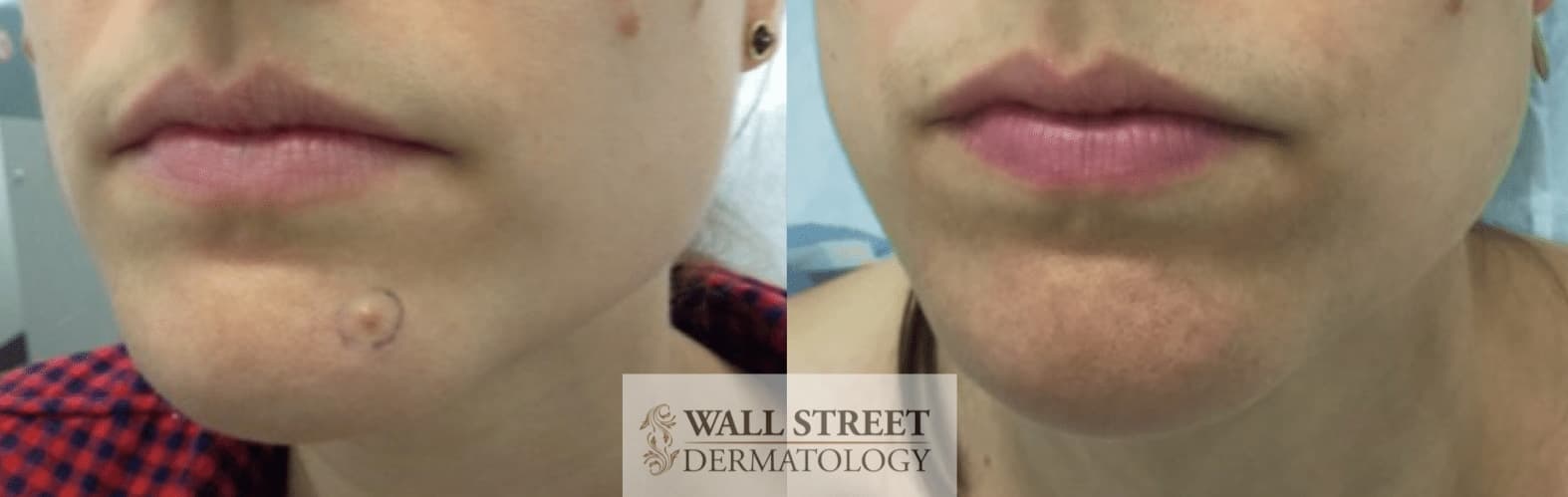 Before and after mole removal procedure result by Dr. Julia Tzu at Wall Street Dermatology